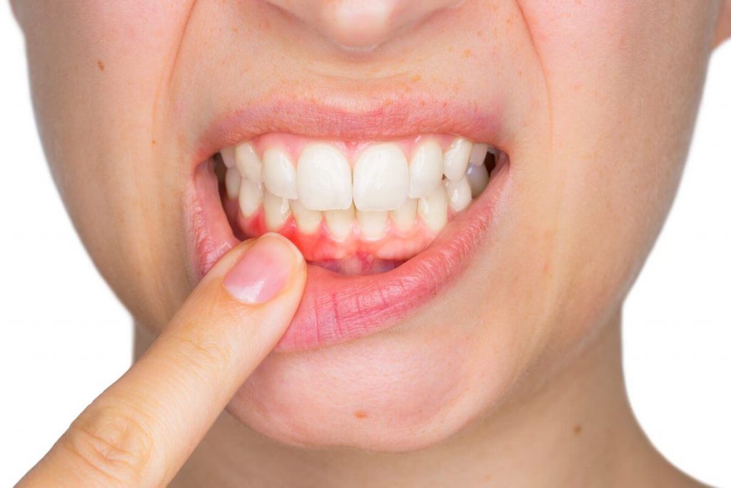 woman suffering with gum periodontitis and Gingivitisproblems need stittsville dentist