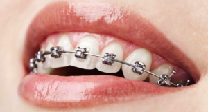 Traditional, ceramic or clear: Which braces to choose - stittsville braces