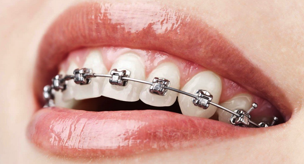 Traditional, ceramic or clear: Which braces to choose?