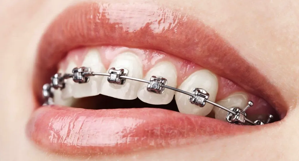 stittsville braces